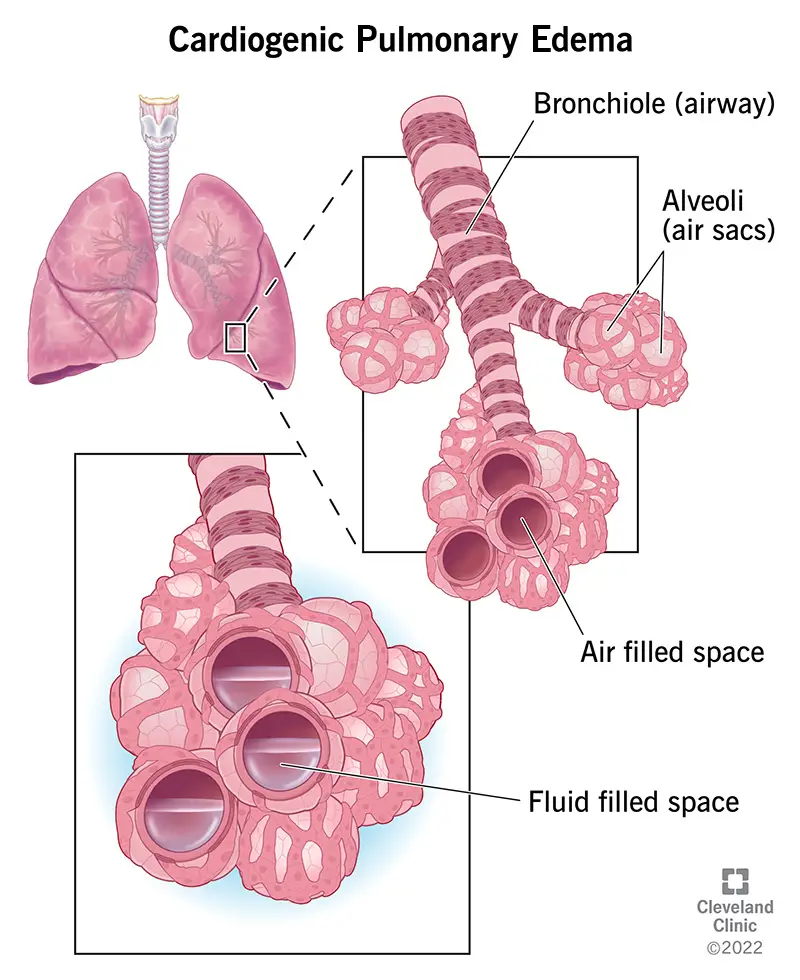 1709017401 22941 cardiogenic pulmonary edema