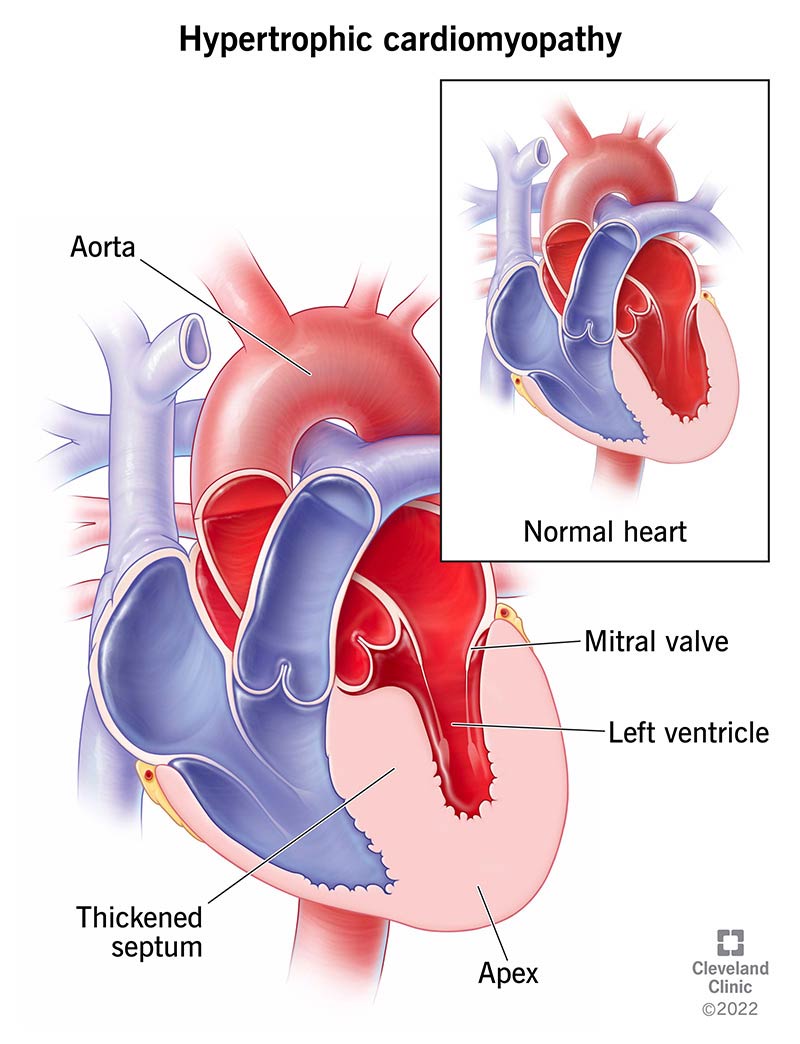 Südamelihase paksenemist põhjustava hüpertroofilise kardiomüopaatia illustratsioon.