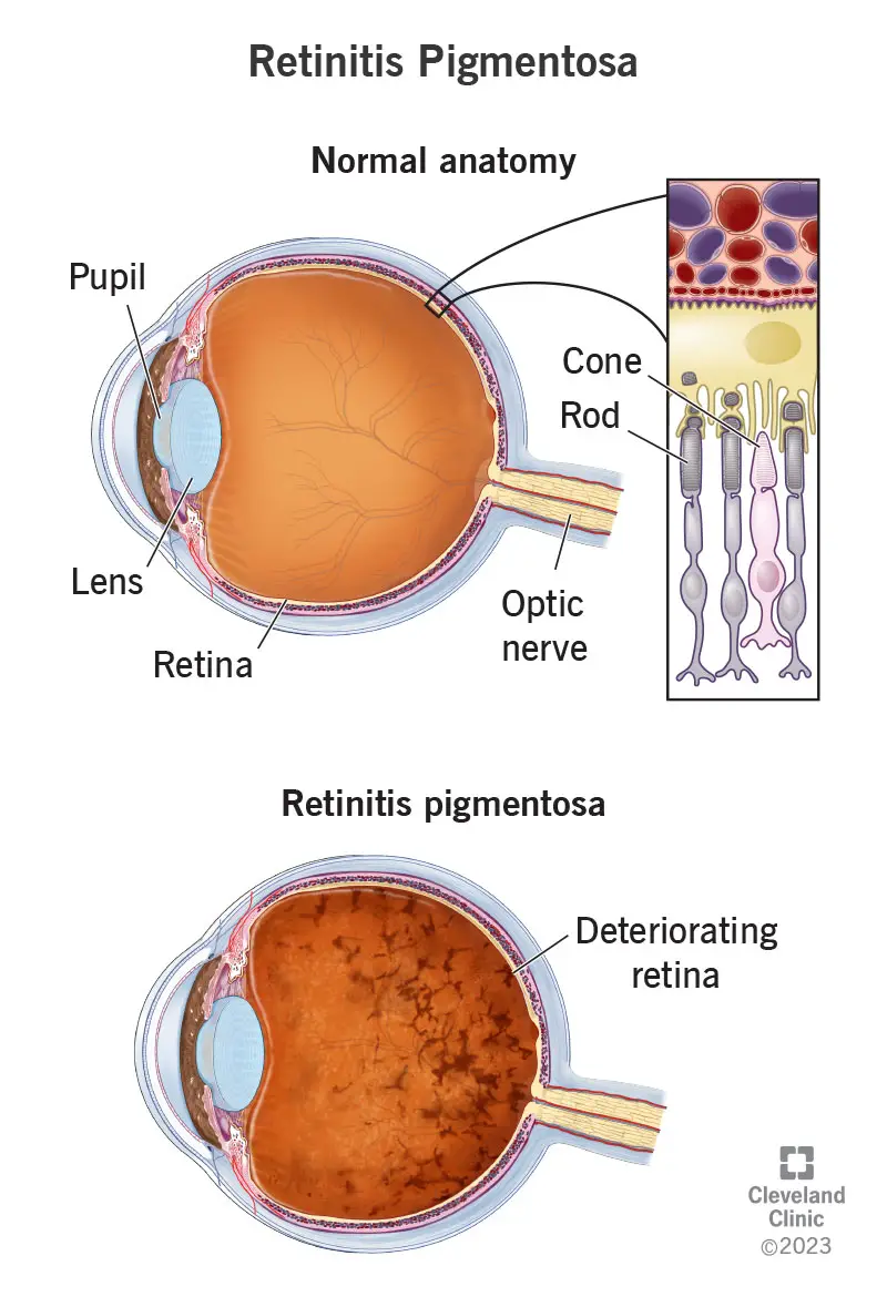 Retinitis pigmentosa mõjutab võrkkesta ja selle koonuseid ja vardaid;  teiste silma osade hulka kuuluvad pupill, lääts ja nägemisnärv.