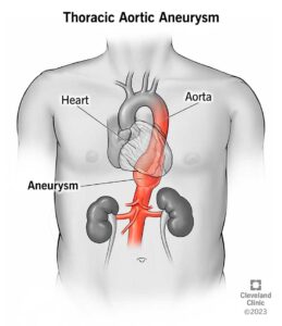 17552 thoracic aoritc aneurym illustration