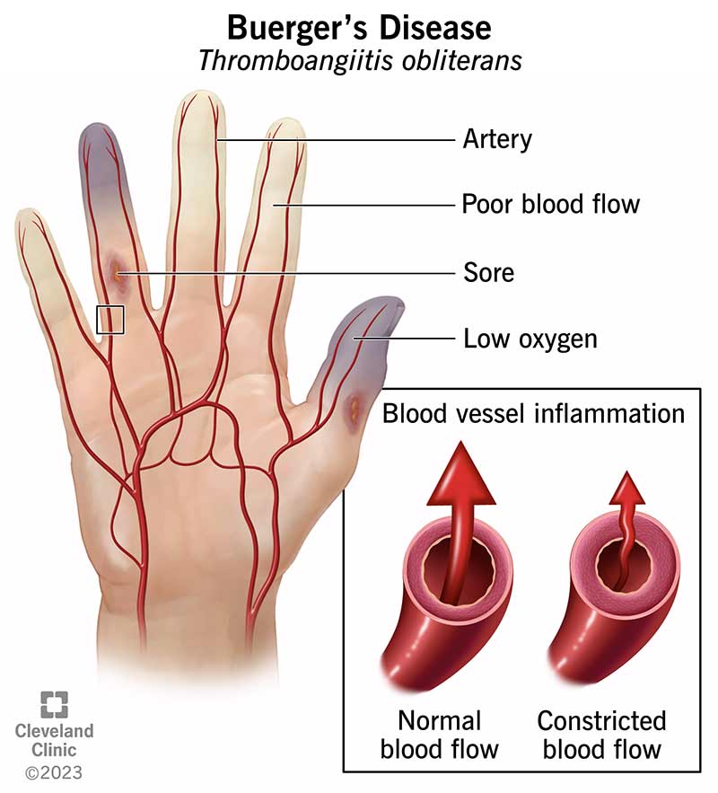 Buergeri tõve korral piirab teie veresoonte põletik verevoolu teie sõrmedes, varvastes, kätes ja jalgades.