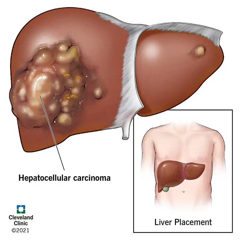 Maksa hepatotsellulaarne kartsinoom