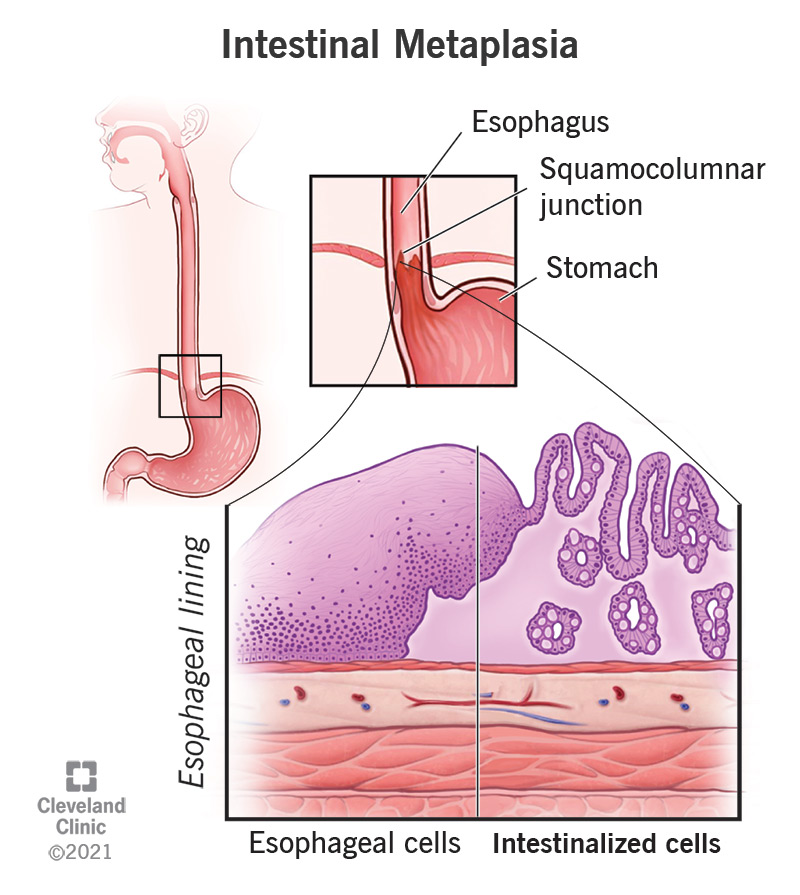 Soole metaplaasia on siis, kui teie mao või söögitoru vooderdavad rakud asenduvad potentsiaalselt vähieelsete rakkudega.