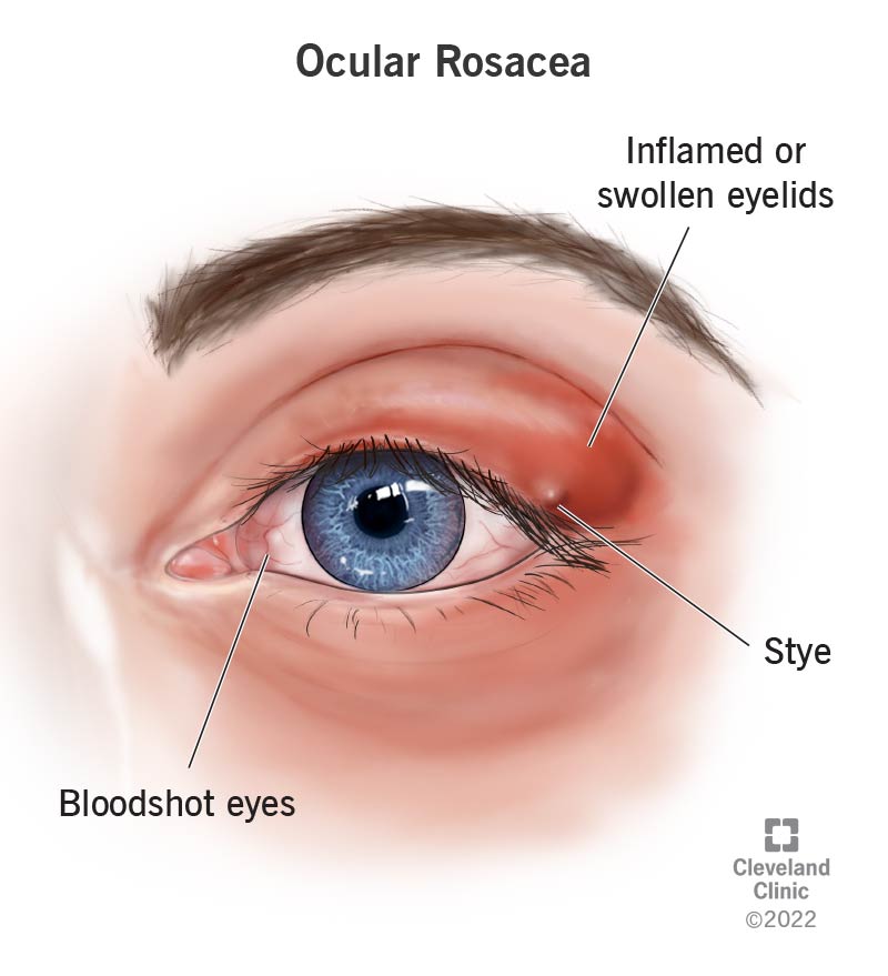 Silma rosaatsea mõjutab silmi ja neid ümbritsevat nahka.