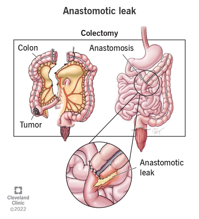 Kui kirurgiline anastomoos ebaõnnestub, tekib anastomootiline leke.