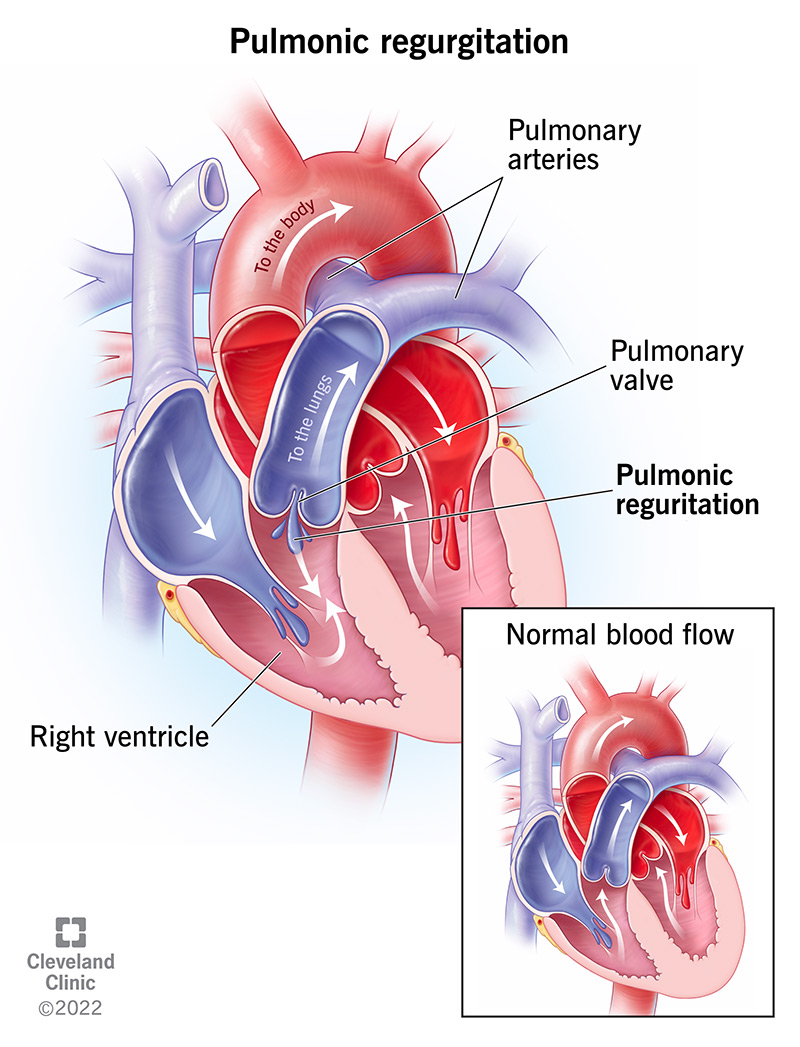 Kopsu regurgitatsioon on siis, kui veri lekib tagasi läbi kopsuklapi, avaldades südamele liiga palju survet.