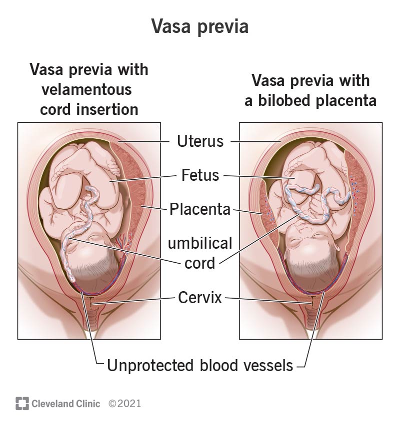 Vasa previa velamentse nööri sisestamisega vs vasa previa kahehöövlilise platsentaga.