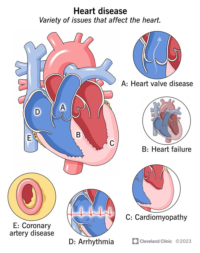 Erinevat tüüpi südamehaigused mõjutavad teie südame erinevaid osi.