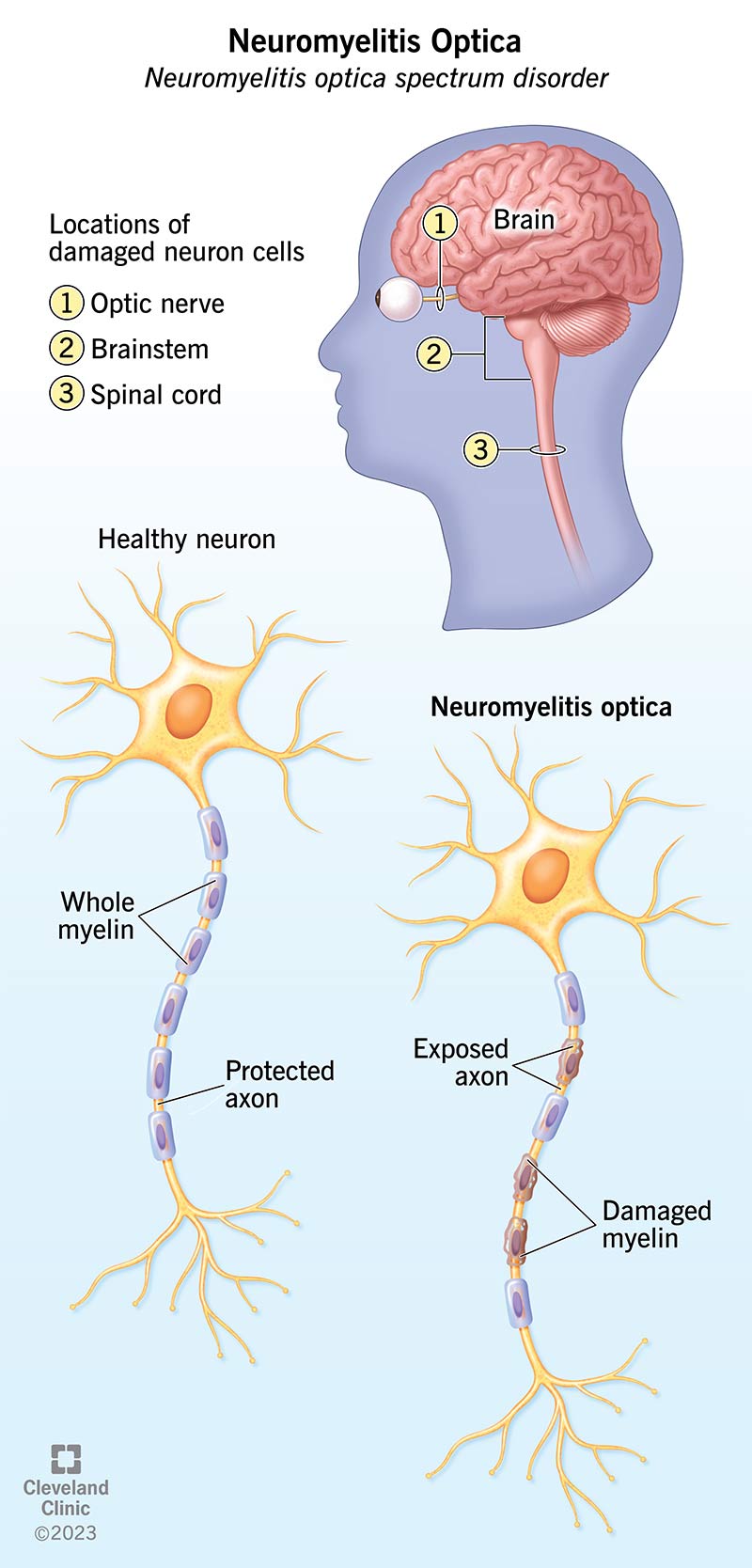 Neuromyelitis optica tekib siis, kui teatud närvirakkude osa ümber olev kaitsekate laguneb, põhjustades närvikahjustusi.