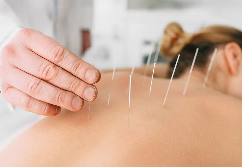 accupuncture 1126093074 770x533 1