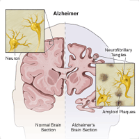 Illustratsioon, mis näitab, kuidas Alzheimeri tõbi mõjutab aju