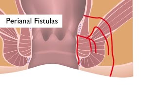 Perianaalsete fistulite uurimise tähelepanu keskpunktis Johns Hopkins Meyerhoffi IBD keskus