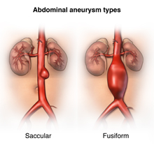 Erinevat tüüpi aordi aneurüsmid