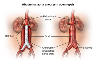 Kõhu aneurüsmi siiriku parandamine