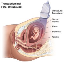 achondroplasiastaywell161393