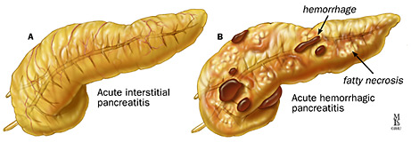 acute pancreatitis