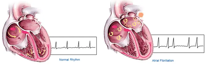 afib illustratsioon