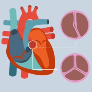 bicuspid aortic valve graphic