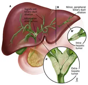 bile duct cancer