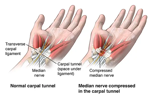 carpal tunnel