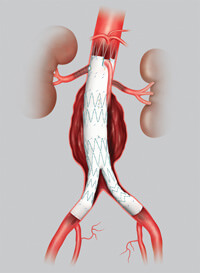 Fenestreeritud stendi transplantaat kõhuaordi aneurüsmi jaoks