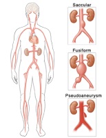 Aordi aneurüsmi erinevat tüüpi illustratsioon