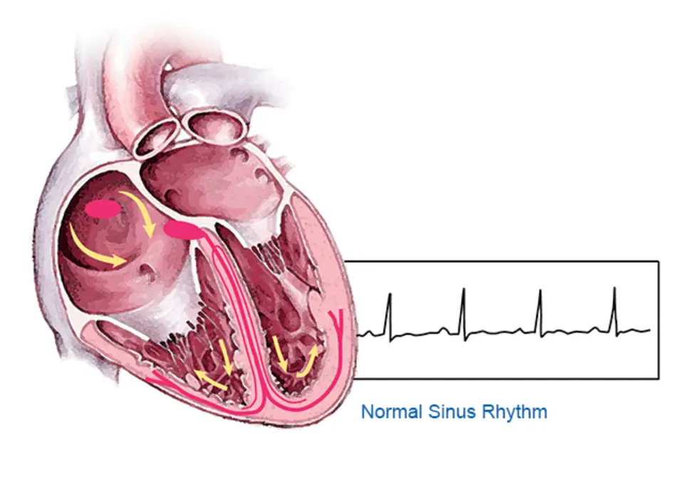 normal sinus rhythm