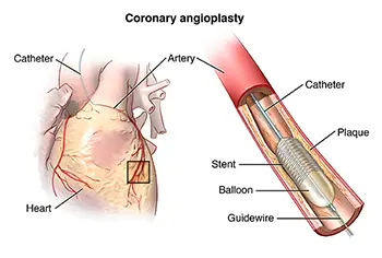 Koronaarangioplastika