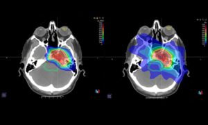 proton therapy brain scan