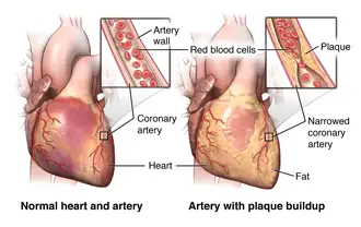 Süda ja arterid ning naastude kogunemine arterite seintesse