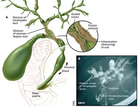 A: Intrahepaatilised ja ekstrahepaatilised striktuurid primaarse skleroseeriva kolangiidiga patsiendil;  B: vastav ERCP kolangiogramm. 