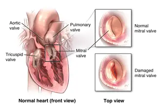 Normaalne ja kahjustatud mitraalklapp