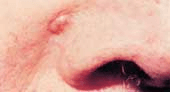 basal cell carcinoma