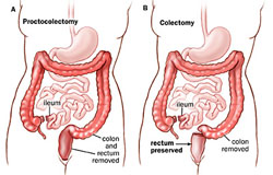 comparisonofproctocolectomyandcolectomysurgicalprocedures290570