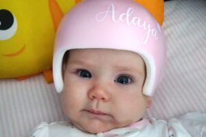 craniosynostosis adaya helmet bodycopy