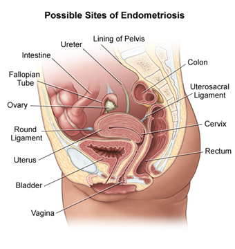 Graafika näitab, kus endometrioos naise kehas areneb