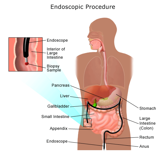 Endoskoopilise protseduuri illustratsioon.