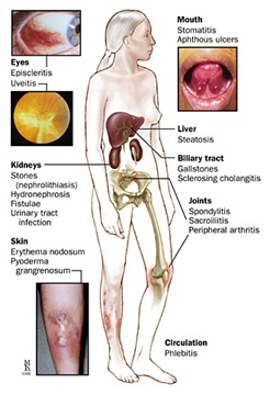 extraintestinal manifestations of crohns disease