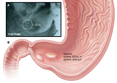 gastriculcer