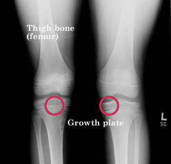 Põlvede röntgen, kasvuplaatide asukoha tuvastamine