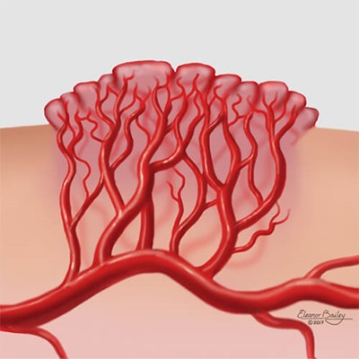 Infantiilset hemangioomi põhjustavate veresoonte rühmituse illustratsioon. 