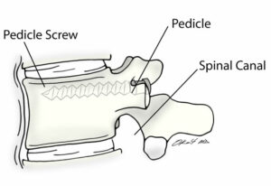 illustration pedicle screw side.ashx