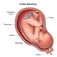 Illustratsioon, mis näitab nähtavat verejooksu raseduse ajal