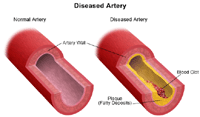 Normaalse ja haige arteri illustratsioon