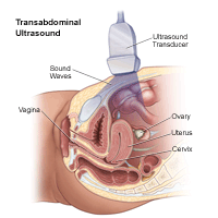 Illustratsioon transabdominaalsest ultraheliprotseduurist