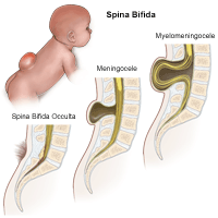 Kolme erineva astme spina bifida illustratsioon
