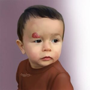 infantile hemangioma