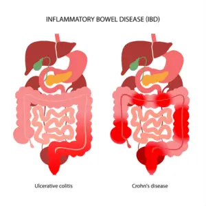 inflammatory bowel disease graphic large