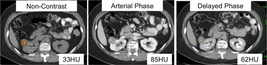 kidney cancer diagnosis triptych noncontrast arterial phase delayed phase