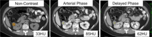 kidney cancer diagnosis triptych noncontrast arterial phase delayed phase